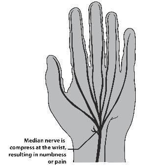 This is a diagram of a hand and shows the Median nerve that becomes compressed and results in numbness or pain - usually leads to carpal tunnel syndrome
